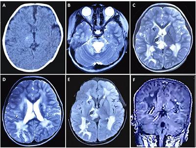 Case Report: Clinical Features of Childhood Leukoencephalopathy With Cerebral Calcifications and Cysts Due to SNORD118 Variants